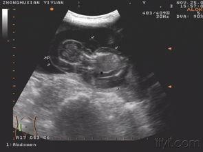 婴儿水肿照片,成因、症状及应对策略